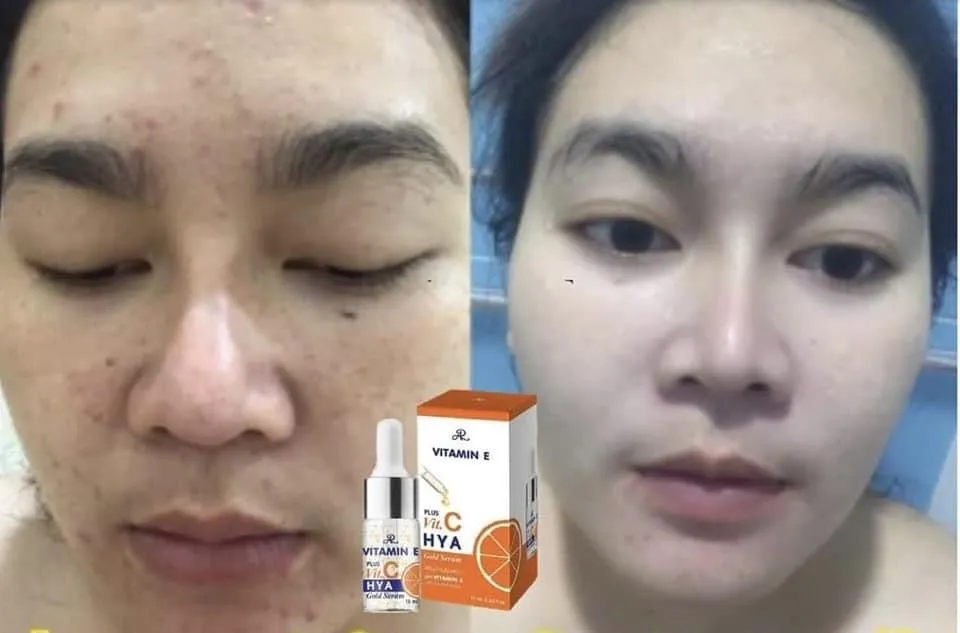 AR Vitamin E plus Vit C HYA Gold serum 10ml